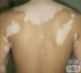 白癜风吃角瓜行吗,白癜风患者的天然食疗选择